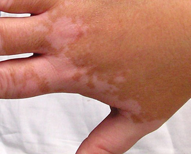 Tâches blanches survenant au niveau de la peau : apport de la photothérapie